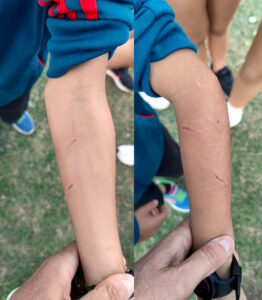 Lesiones tras el incidente del 08/10/2026 Lesiones documentadas tras un incidente con un perro durante un entrenamiento en octubre de 2026